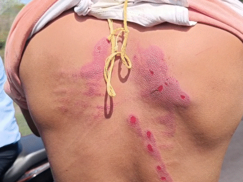 धनबाद में कोयला चोरों की दबंगई:स्पेशल ब्रांच एएसआई और पत्नी को दौड़ा-दौड़ा कर पीटा, रास्ता देने को लेकर बढ़ा विवाद