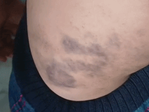 गुरदासपुर में छात्र को विकटों से पीटा:टीचर ने घर में बताने पर धमकी दी, मां ने कपड़े बदलते वक्त निशान देखे; स्कूल पहुंची