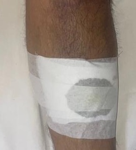 सिरसा में पड़ोसियों ने घर में घुसकर किया हमला:बहस के बीच तलवार और कापा से वार; महिला, पति व देवर लहूलुहान