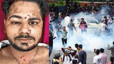 ‘I thought he was only trying to scare me’: CJP protester recalls being shot in face by pellet gun | Delhi News